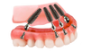 Alexandria Dental Center - Specializing in Dental Implants, All on X, Invisalign
