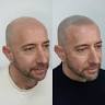 MICROPIGMENTACIÓN CAPILAR EXTREMADURA · Hair Design